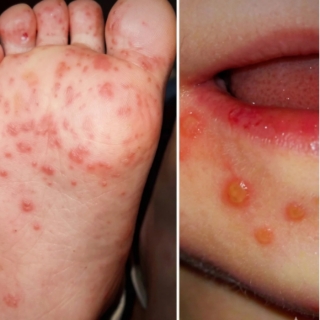 Dòng chảy sự kiện - Cảnh báo từ chủng EV71 và giải pháp giảm ca nặng